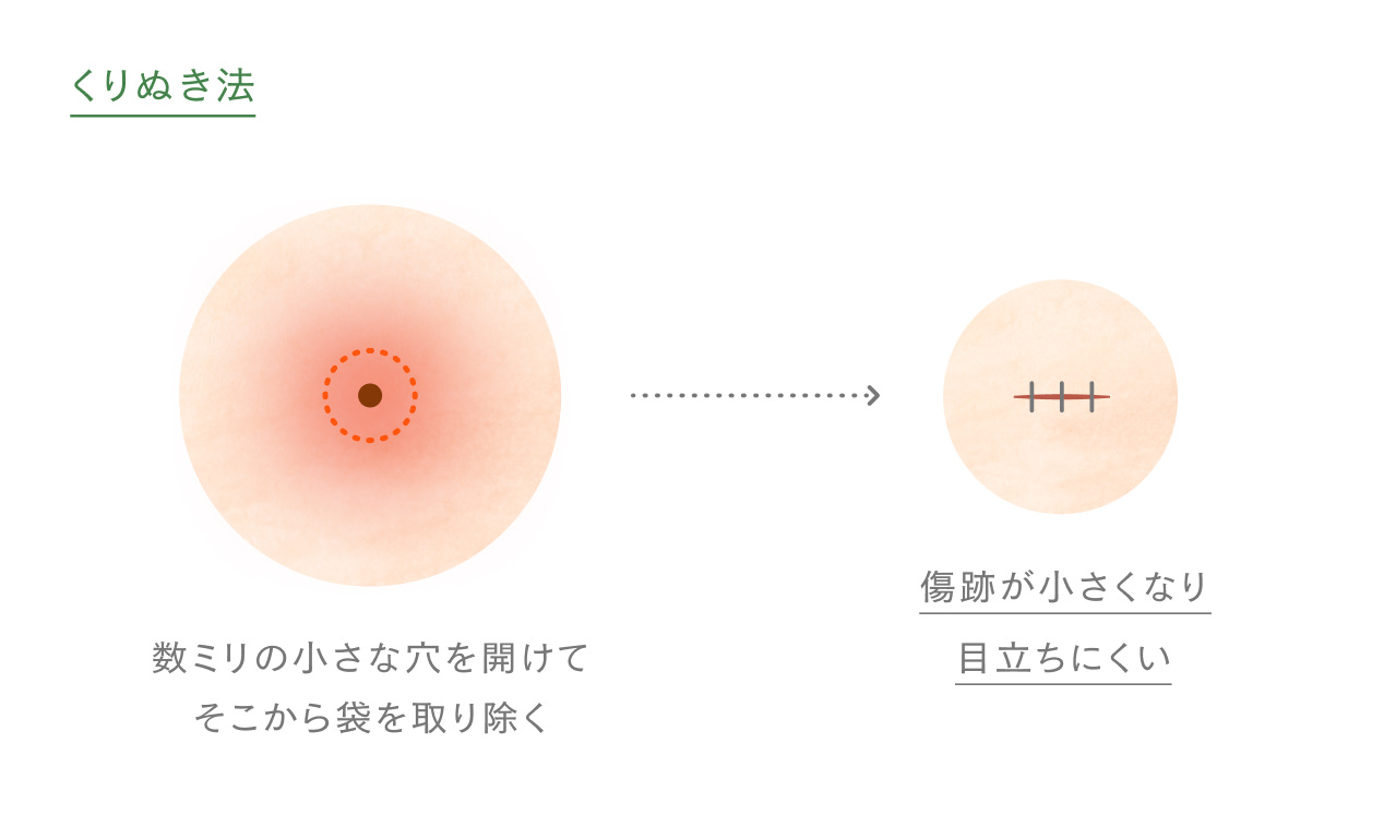 くりぬき法のイメージ図
