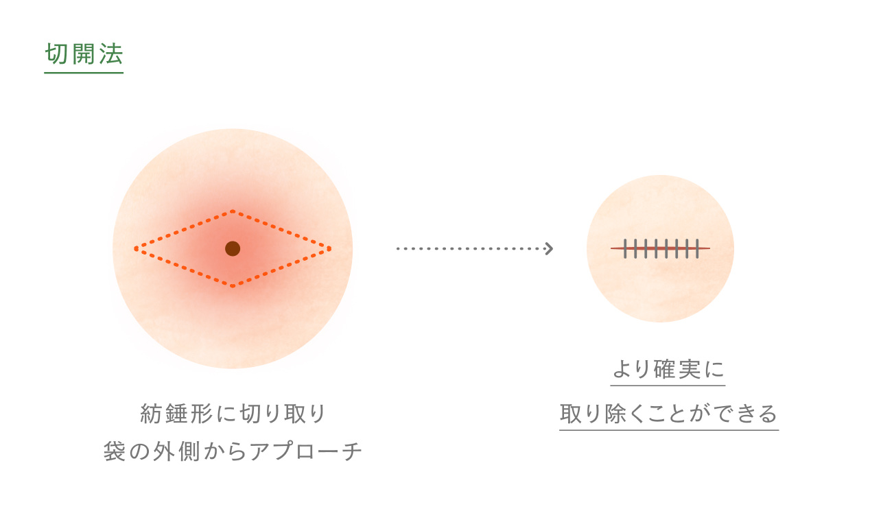 切開法のイメージ図