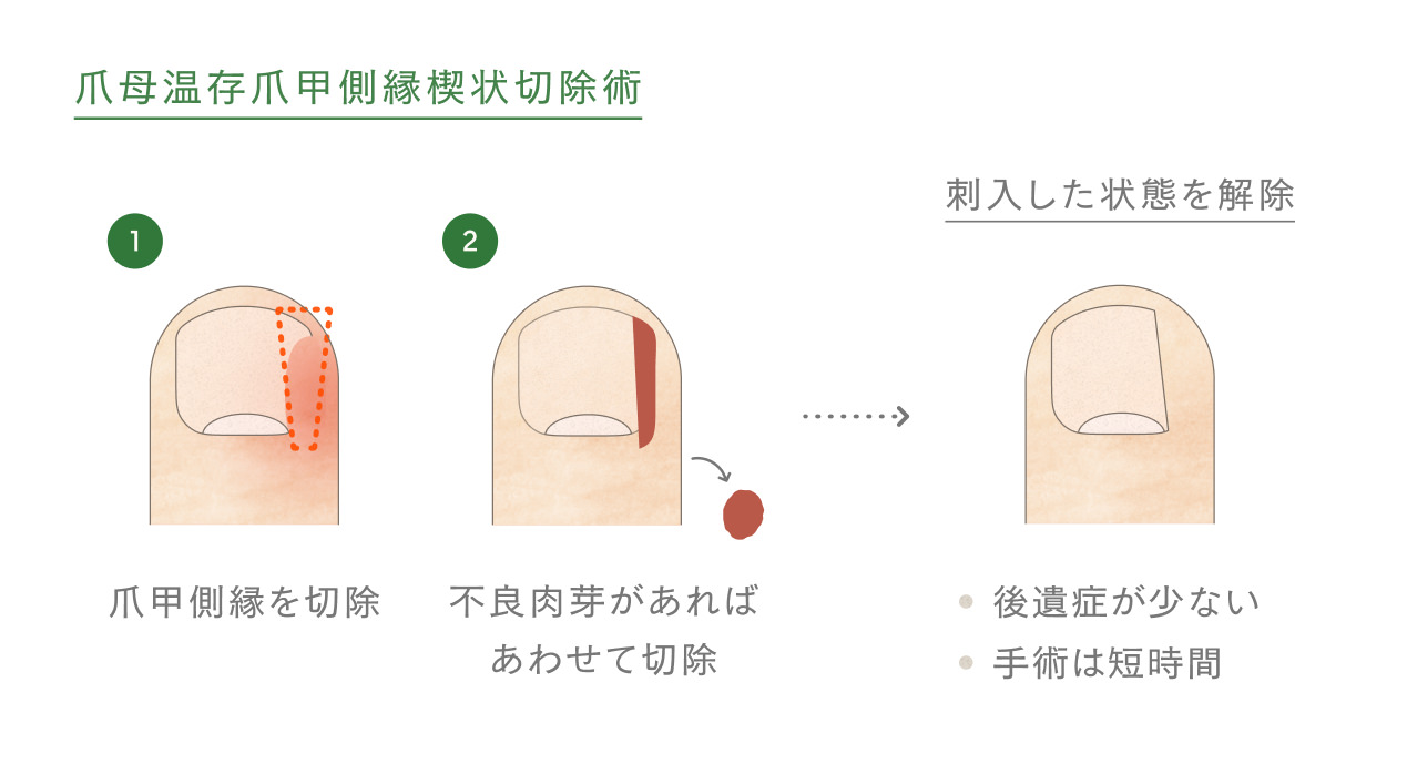 爪母温存爪甲側縁楔状切除術の図