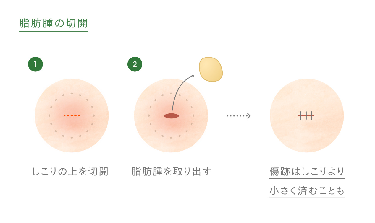 脂肪腫の切開のイメージ図