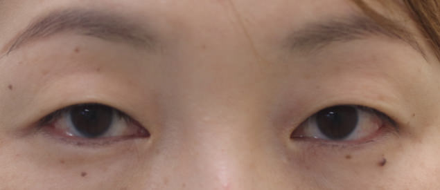 眼瞼下垂のイメージ写真（カラー）