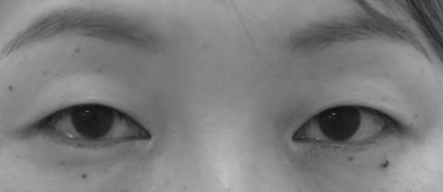 眼瞼下垂のイメージ写真